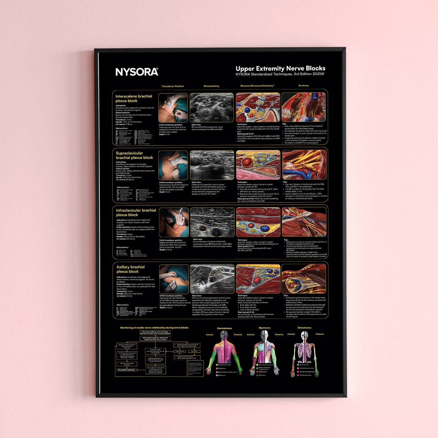 Upper Extremity Nerve Blocks Poster